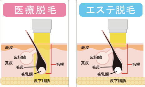 エステサロンの脱毛は光脱毛