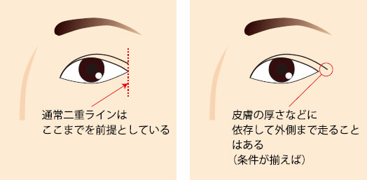 目尻側の二重ラインが消えた