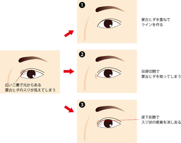 元からあった蒙古ヒダの線が二重ラインの下に見える