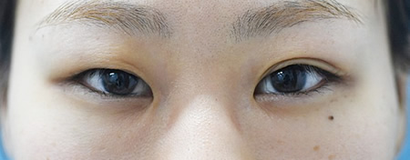 二重埋没法によって左右差を改善する