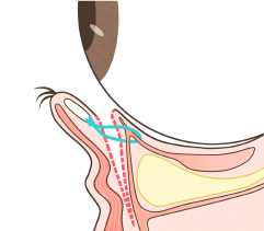 まぶた裏側からのアプローチ・CPF法/Capsulo-palpebral fascia(眼瞼筋膜)の短縮