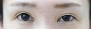 二重切開法の術後に眠たそうな目になった症例