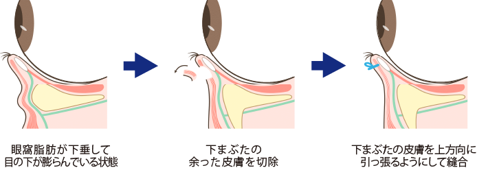 皮膚切除