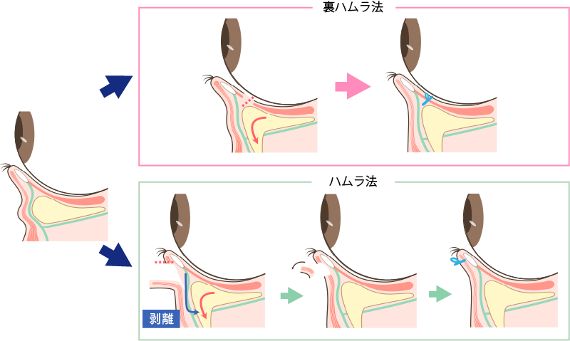 裏ハムラ法とハムラ法の違い