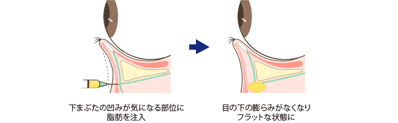裏ハムラ法