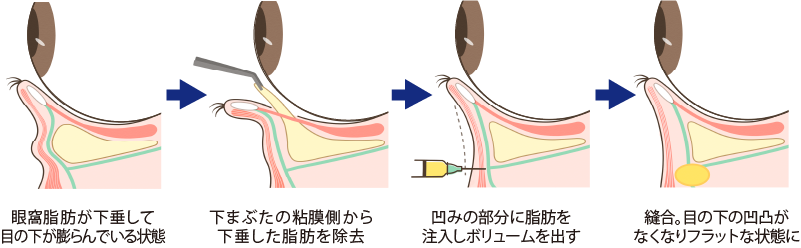 裏ハムラ法