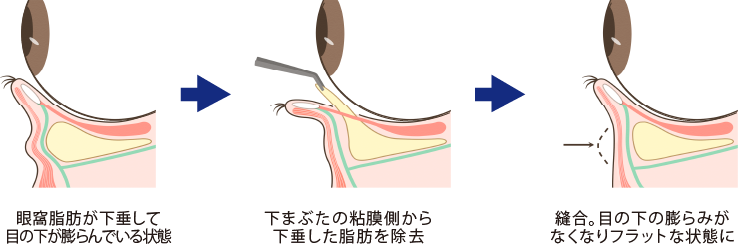 脱脂法