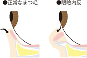 睫毛内反症