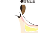 睫毛乱生