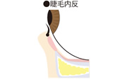 眼瞼内反