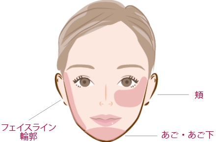 たれ目形成(アーモンドアイ)