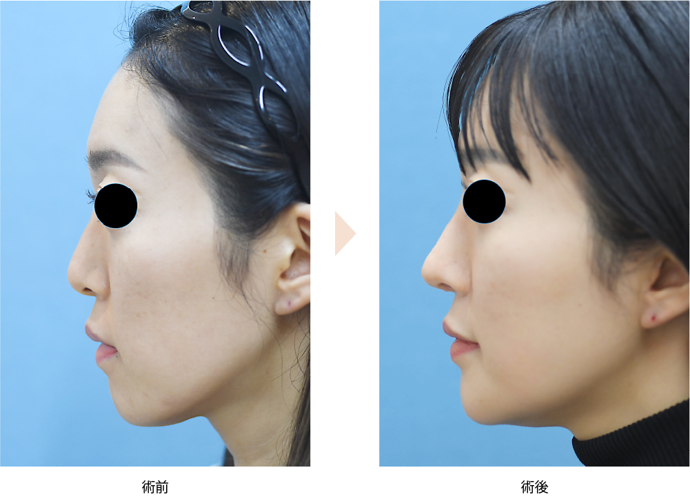 「Vライン・Eライン形成／正面と横顔の両方における小顔輪郭整形」の症例写真・ビフォーアフター