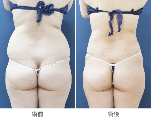 「ベイザー×アキーセル脂肪吸引(腰部)」の症例写真・ビフォーアフター