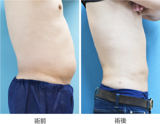 「ベイザー×アキーセル脂肪吸引(上腹部・下腹部・両側腰部)」の症例写真・ビフォーアフター