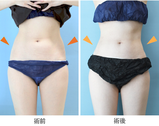 「腰部の脂肪吸引(痩せ型の方でも可能)」の症例写真・ビフォーアフター