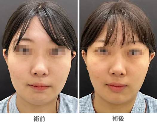 「ベイザー×アキーセル脂肪吸引(腰部)」の症例写真・ビフォーアフター