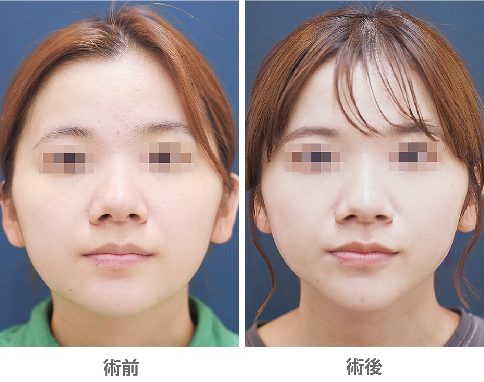 「ジョールファット除去(Vライン形成/ベイザー使用)」の症例写真・ビフォーアフター