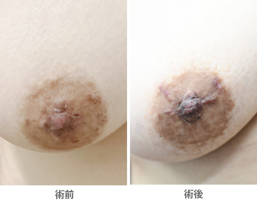 「陥没乳頭術の応用(乳頭形成・乳頭再建/乳輪縮小術後に平坦化した乳頭の修正)」の症例写真・ビフォーアフター