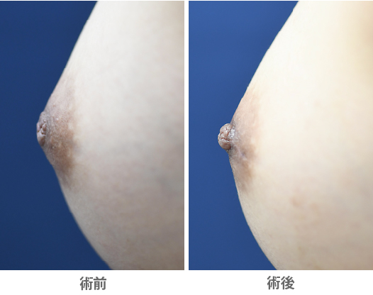 「陥没乳頭治療(保険診料)」の症例写真・ビフォーアフター