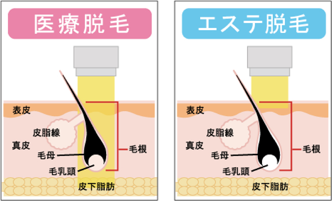 エステ脱毛と医療脱毛の機器の違い