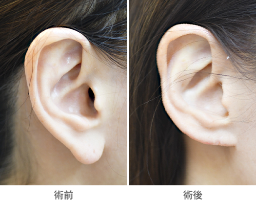 「耳垂縮小術(耳たぶを小さく見せる耳形成術)」の症例写真・ビフォーアフター