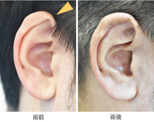 「耳輪形成術(尖り耳修正/尖り感のある耳を滑らかにする)」の症例写真・ビフォーアフター