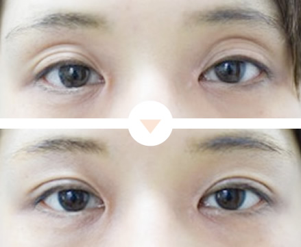 三重まぶたを治したい
