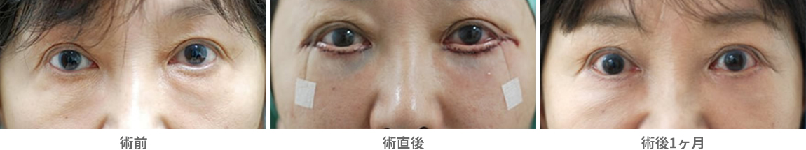「下まぶたたるみ取り(ハムラ法)」の症例写真・ビフォーアフター