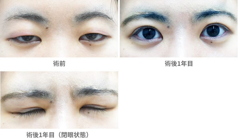 「眼瞼下垂手術/大腿筋膜移植(先天性眼瞼下垂)」の症例写真・ビフォーアフター