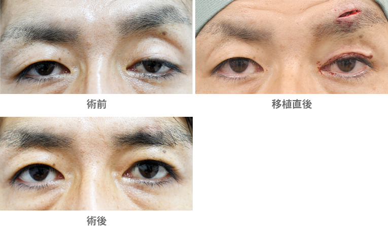 「眼瞼下垂手術/大腿筋膜移植(先天性眼瞼下垂)」の症例写真・ビフォーアフター