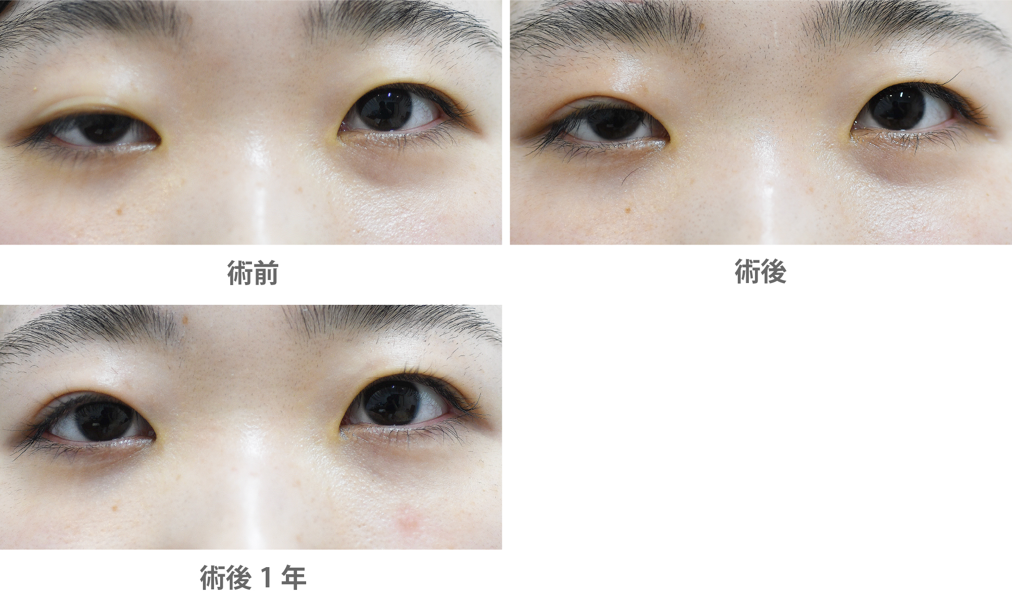 「眼瞼下垂手術/大腿筋膜移植(先天性眼瞼下垂)」の症例写真・ビフォーアフター