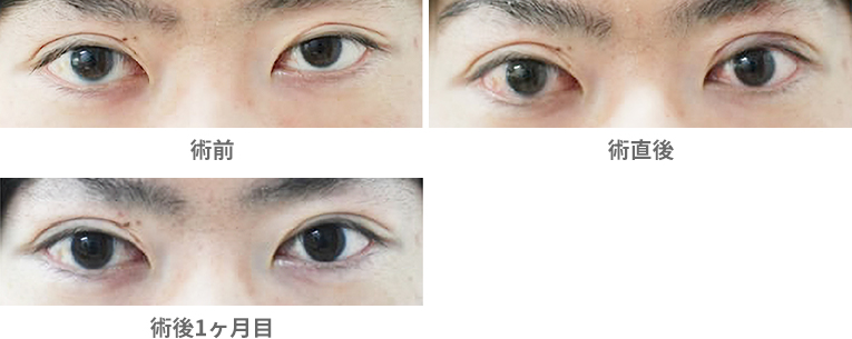 「眼瞼下垂手術(挙筋腱膜前転法)・自由診療」の症例写真・ビフォーアフター