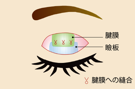 切開を伴う眼瞼下垂術(眼瞼挙筋前転法)