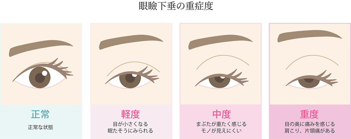 眼瞼下垂の重症度