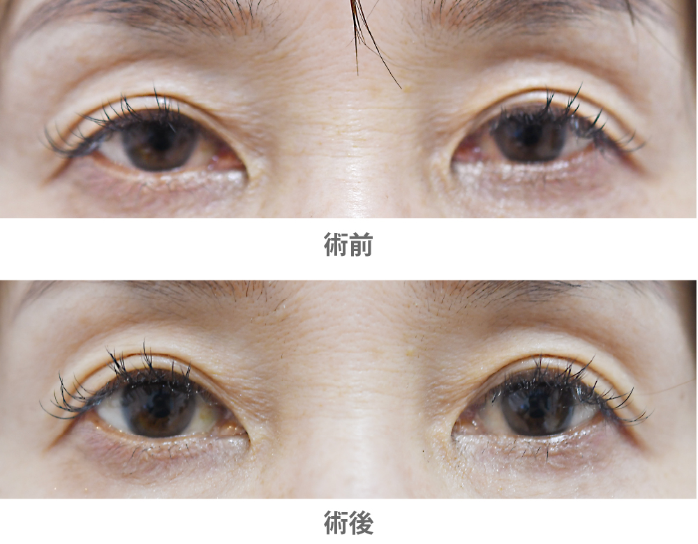 「アップニーク点眼(切らない眼瞼下垂治療)」の症例写真・ビフォーアフター