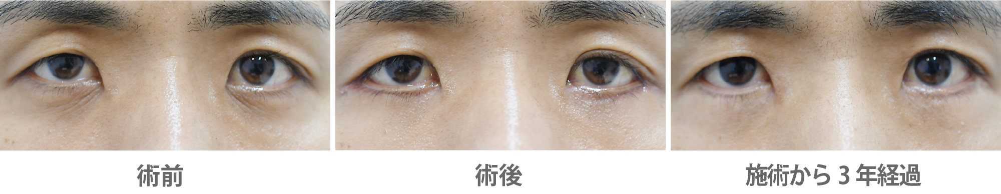 「目の下のたるみ・クマ取り(皮膚切除法)」の症例写真・ビフォーアフター