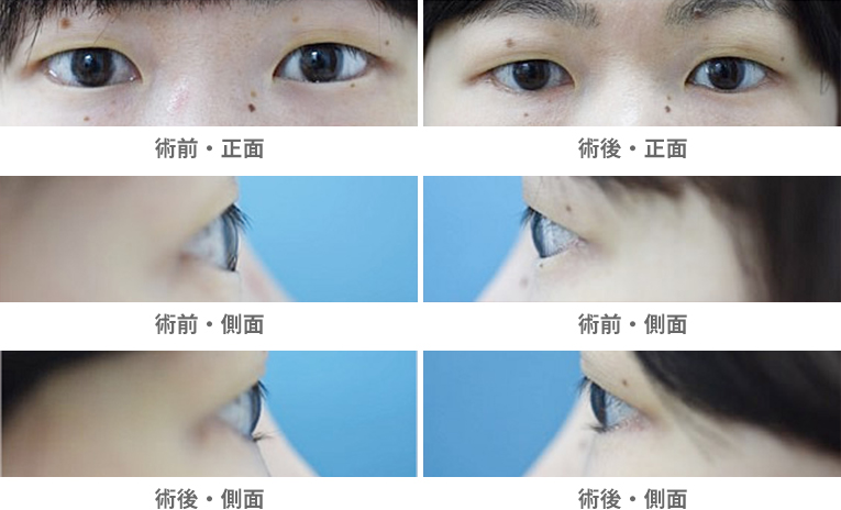 「逆さまつ毛(下まぶた・切開法)※重症例」の症例写真・ビフォーアフター