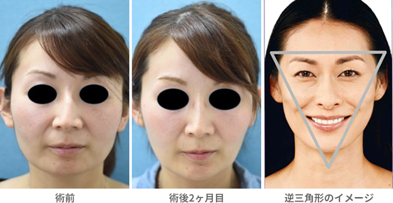 「エラボトックス(小顔注射)」の症例写真・ビフォーアフター
