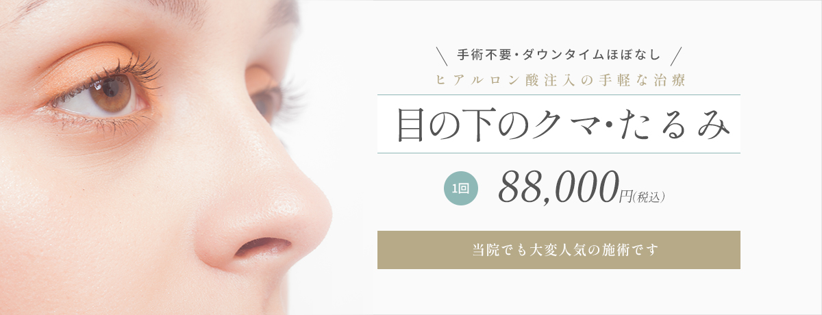 目の下のクマ取り(ヒアルロン酸注入)