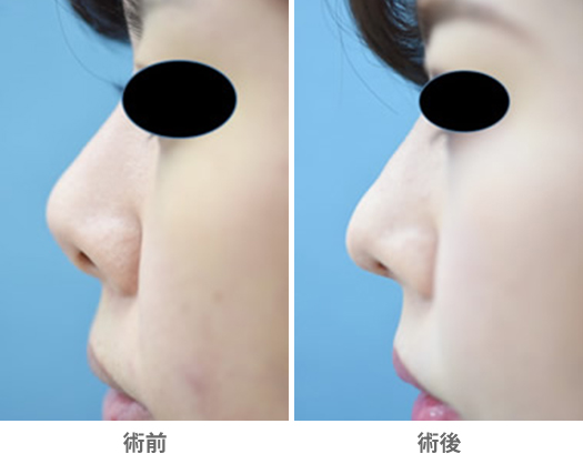 「他院修正:鼻中隔延長術+プロテーゼ加工」の症例写真・ビフォーアフター