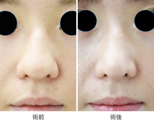 「鼻先の重たさを解消する」の症例写真・ビフォーアフター