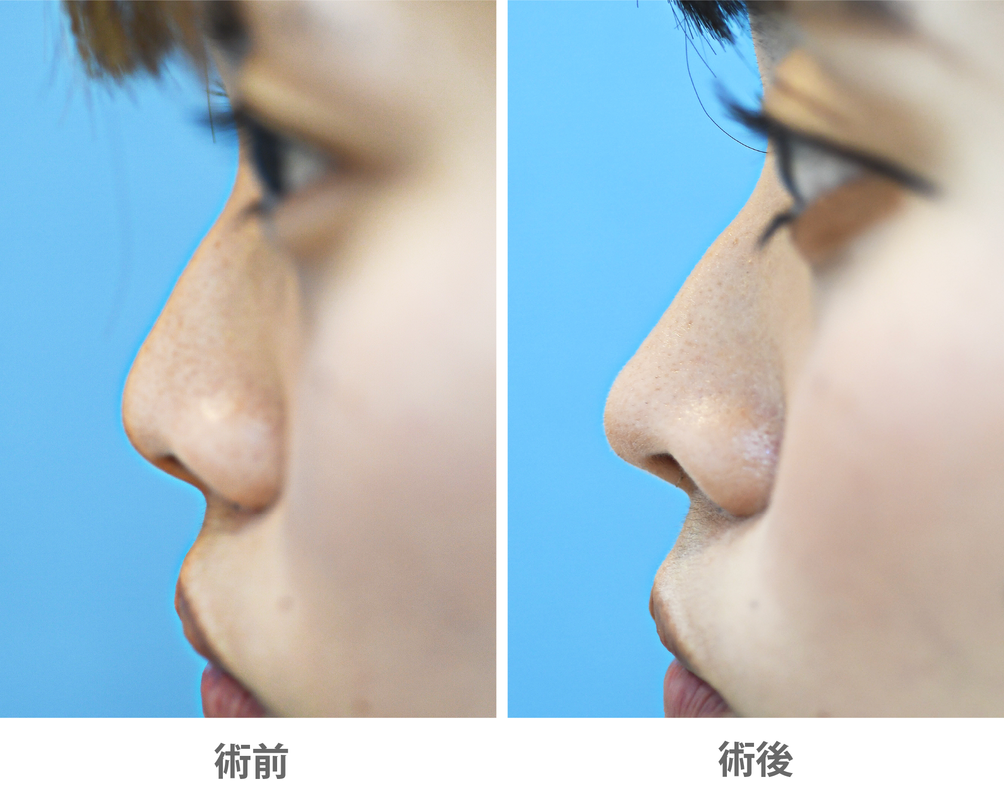 「鼻尖耳介軟骨移植(鼻先に高さを出す)」の症例写真・ビフォーアフター