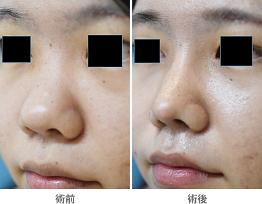 「低くて太い鼻をシャープに見せる②」の症例写真・ビフォーアフター