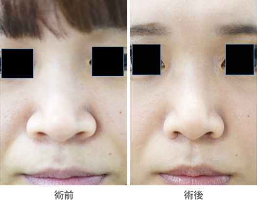 「小鼻縮小術」の症例写真・ビフォーアフター