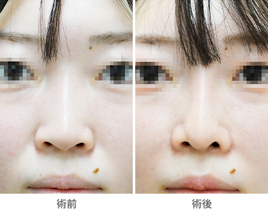 「貴族手術(鼻翼基部プロテーゼ/鼻孔内アプローチ)」の症例写真・ビフォーアフター