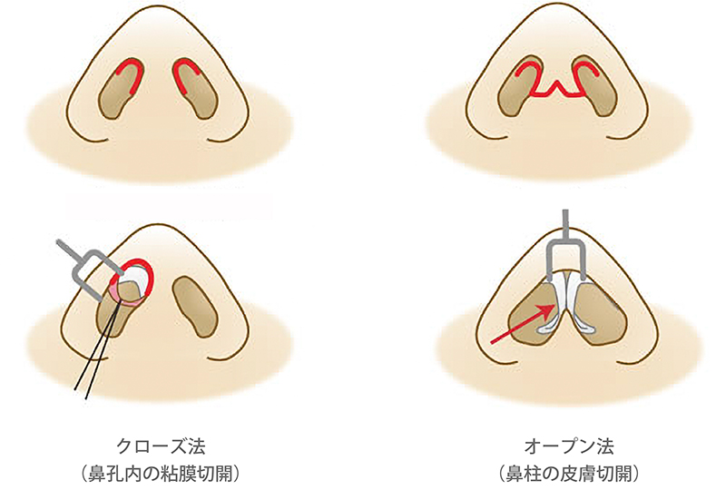 手術のアプローチ法