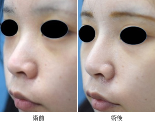 「プロテーゼ挿入」の症例写真・ビフォーアフター