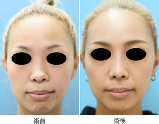 「低くて太い鼻をシャープに見せる①」の症例写真・ビフォーアフター