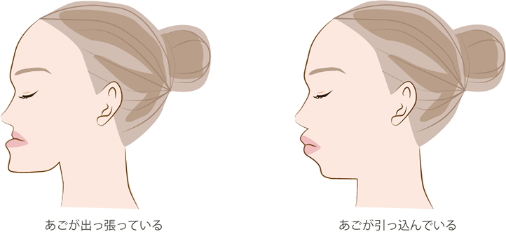 あごの形を変えたい
