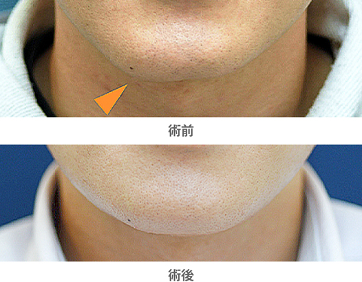 「おとがい形成(顎先の左右差改善)」の症例写真・ビフォーアフター